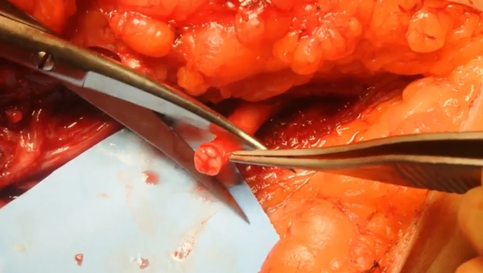 Buncke Nerve Debridement