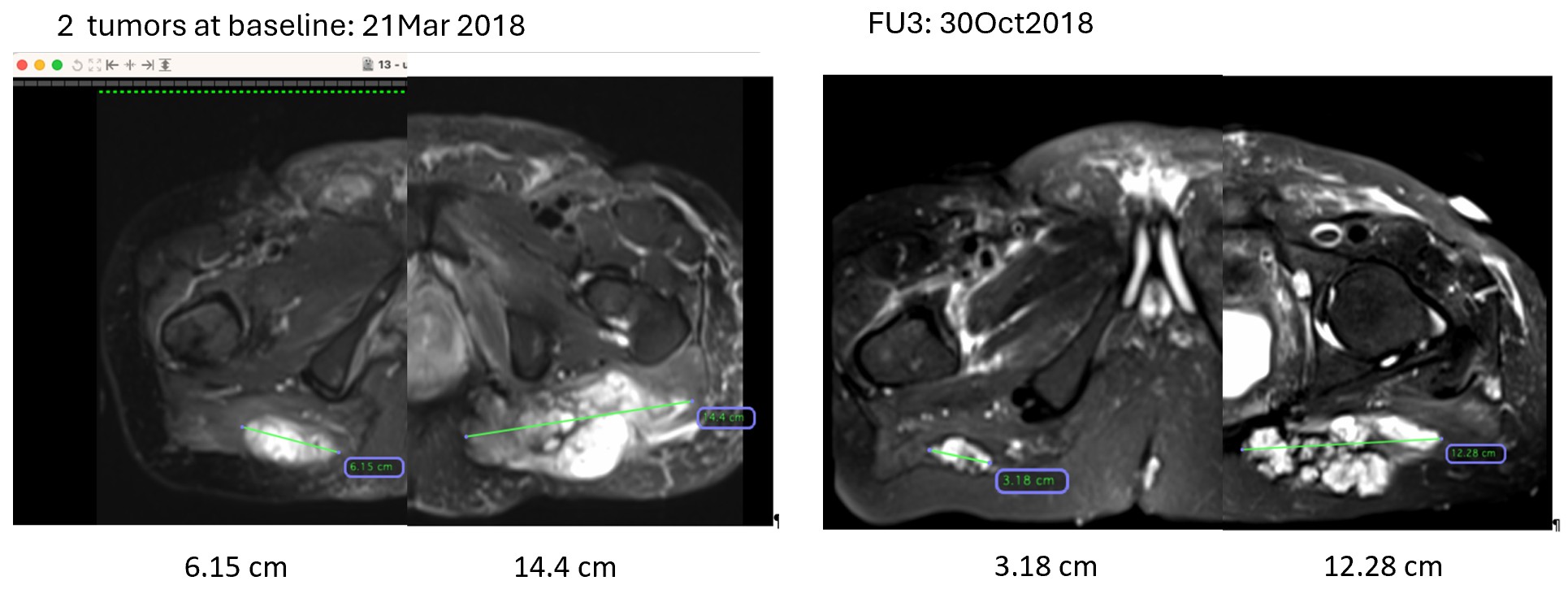 Figure 11 Tumor Necrosis.jpg
